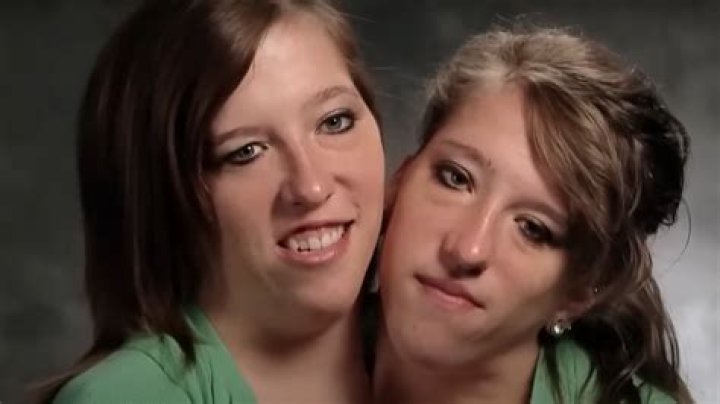 Abby Conjoined Twin Dies: A Heartbreaking Journey and Legacy