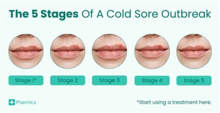 Should Cold Sores Blister Be Popped? A Comprehensive Guide