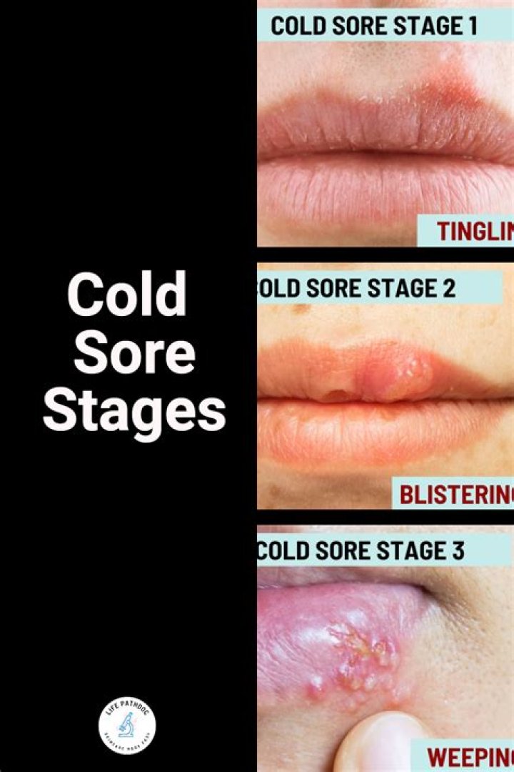 Should You Pop a Cold Sore? What You Need to Know