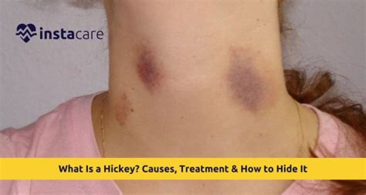 Understanding Neck Hickeys: Causes, Effects, and Treatment Options