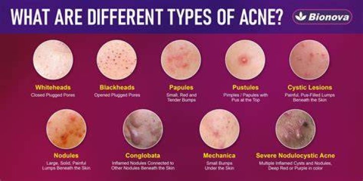 What to Do with a Blind Pimple: Comprehensive Guide for Effective Treatment