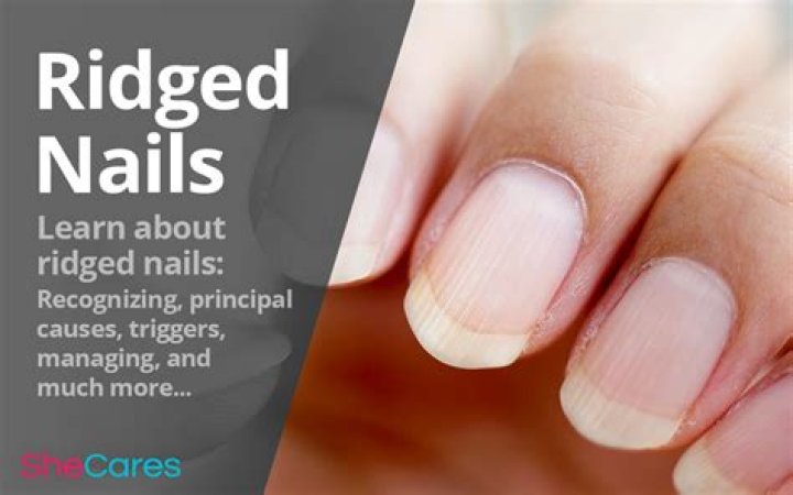 Why Are My Fingernails Ridged? Causes, Treatments, and Prevention